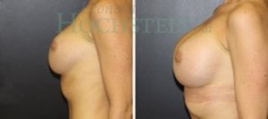 Breast Revision Patient