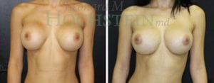 Breast Revision Patient