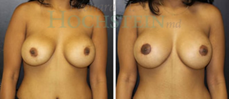 Breast Revision Patient