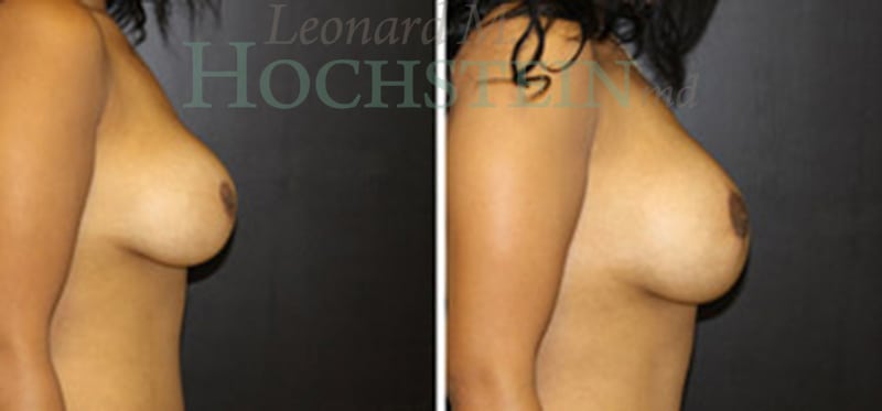 Breast Revision Patient