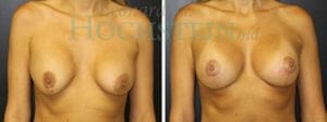 Breast Revision Patient