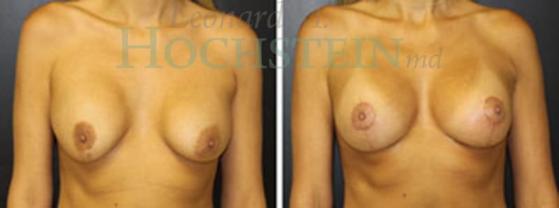 Breast Revision Patient
