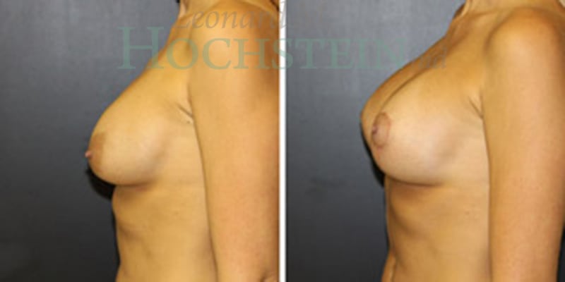 Breast Revision Patient