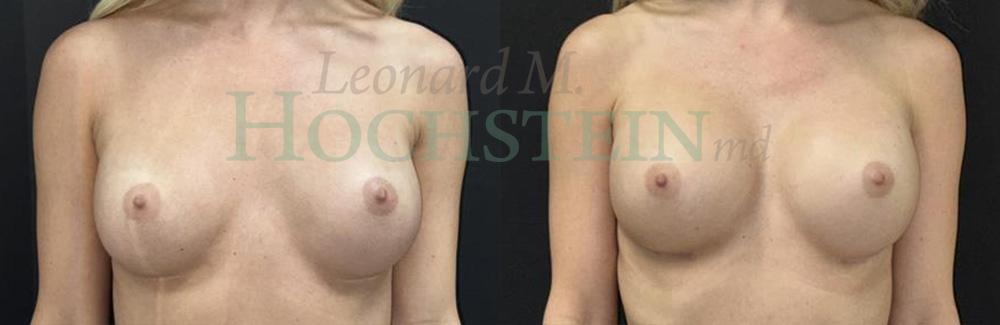 Breast Revision Patient