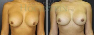 Breast Revision Patient