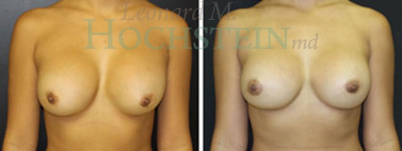 Breast Revision Patient