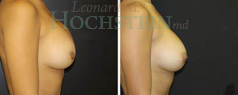 Breast Revision Patient