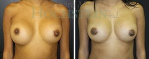 Breast Revision Patient
