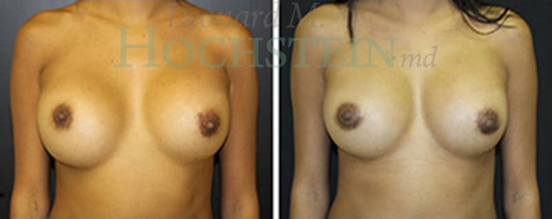 Breast Revision Patient