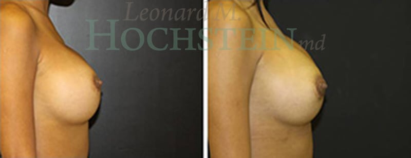 Breast Revision Patient