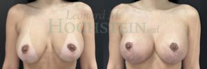 Breast Revision Patient 6834