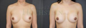 Breast Revision Patient 107
