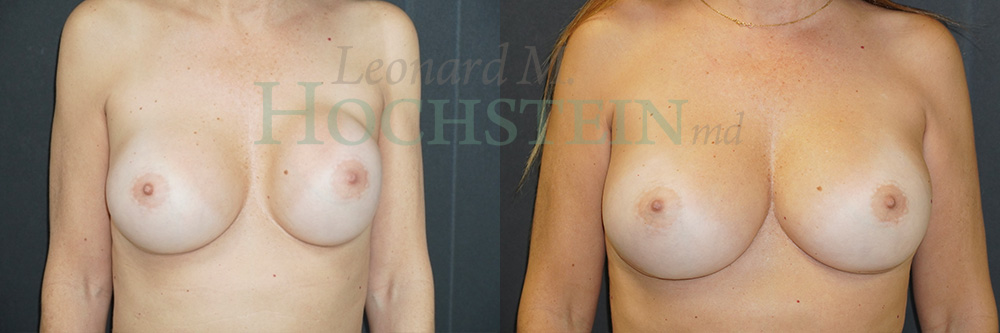Breast Revision Patient