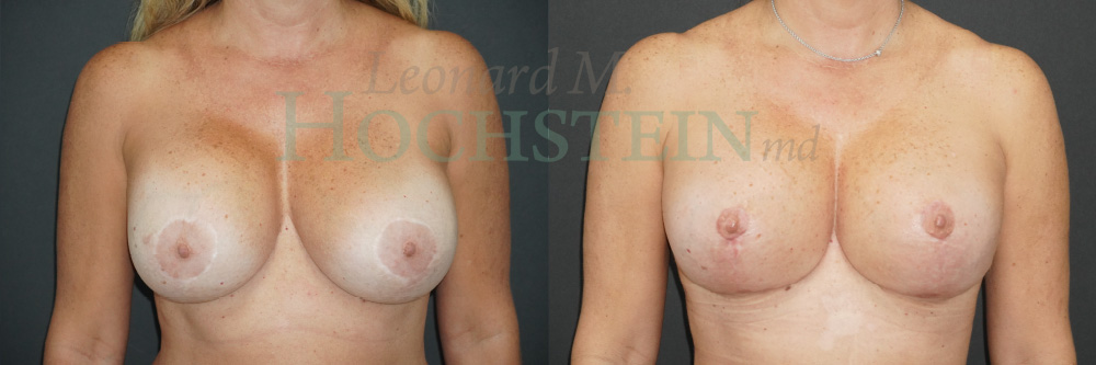 Breast Revision Patient