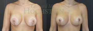 Breast Revision Patient 95