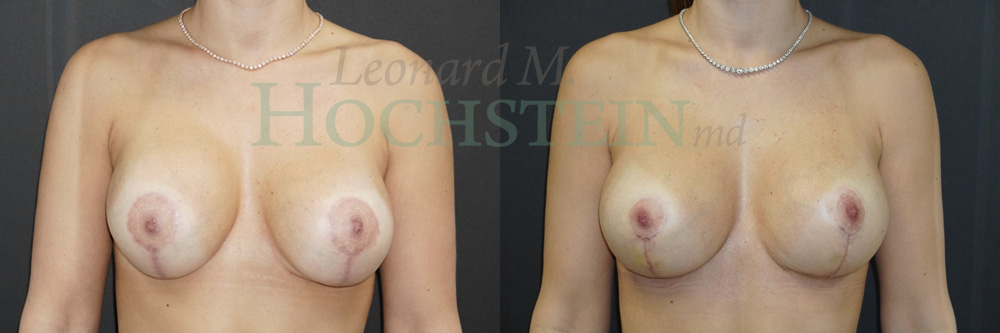 Breast Revision Patient