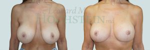 Breast Revision Patient 96