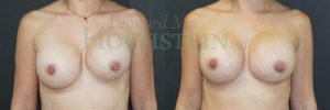 Breast Revision Patient 97