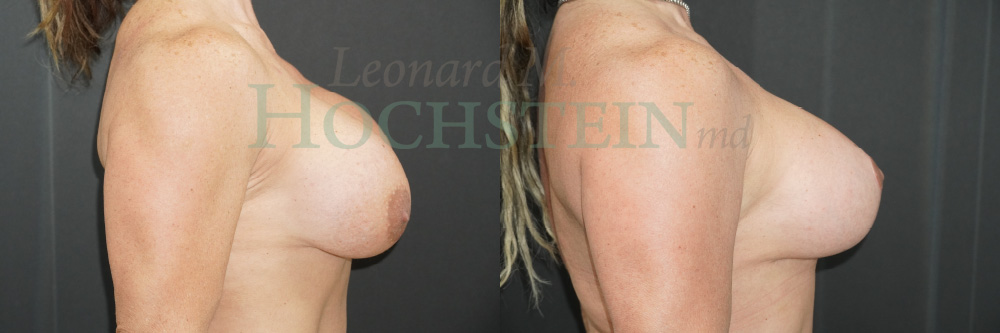 Breast Revision Patient