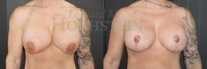 Breast Revision Patient