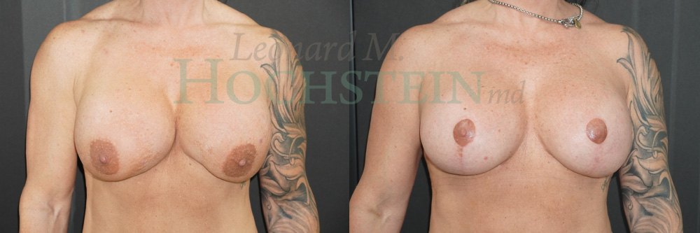 Breast Revision Patient