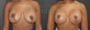Breast Revision Patient 99