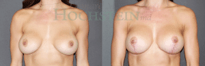 Breast Revision Patient 56
