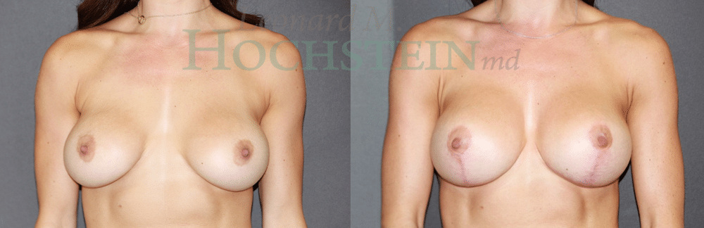 Breast Revision Patient