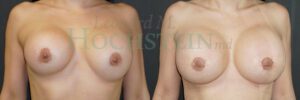 Breast Revision Patient 102