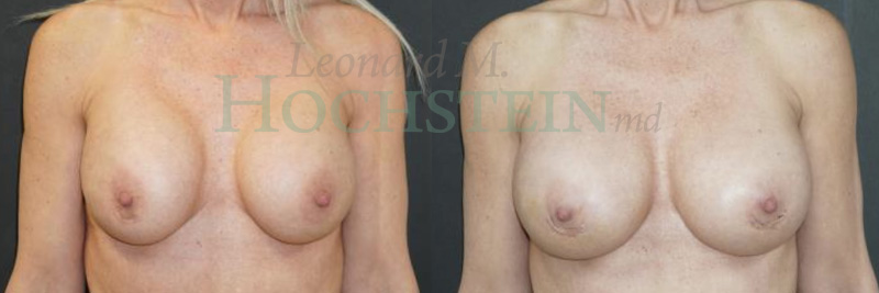 Breast Revision Patient