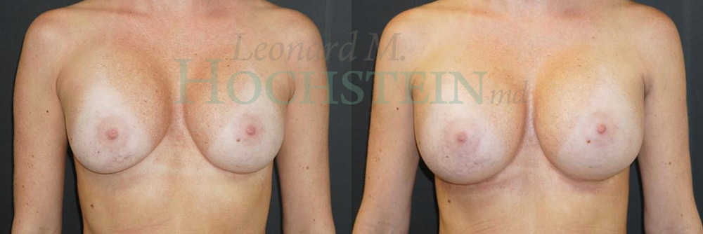 Breast Revision Patient