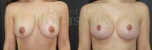Breast Revision Patient 105