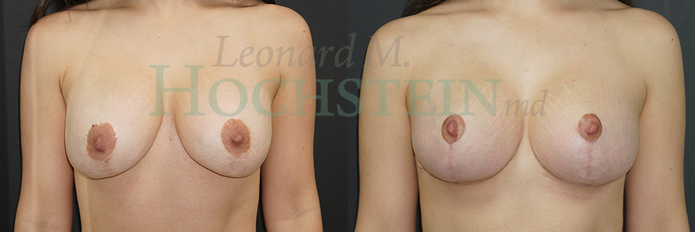 Breast Revision Patient