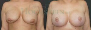 Breast Lift Patient 205