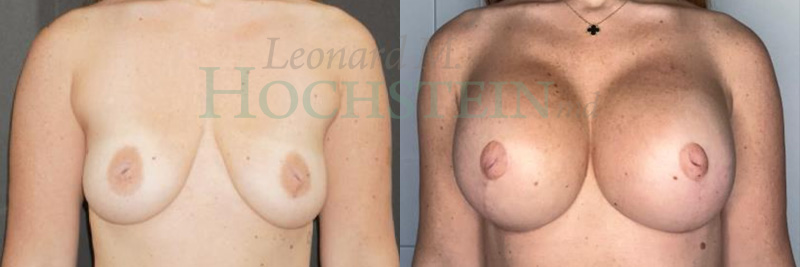 Breast Lift With Implants Patient