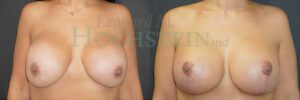 Breast Lift Patient 204