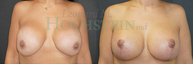 Breast Lift With Implants Patient