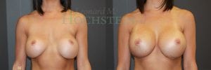 Breast Revision Patient