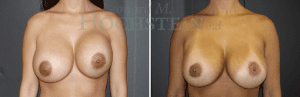 Breast Revision Patient