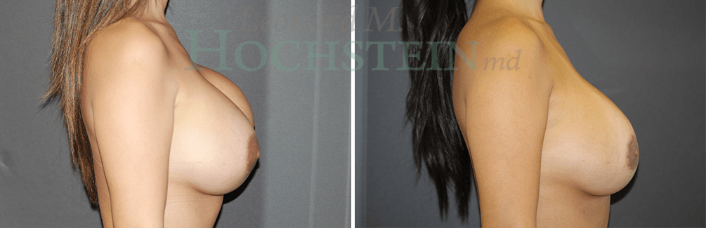 Breast Revision Patient