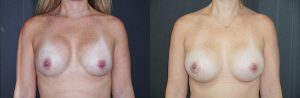 Breast Revision Patient