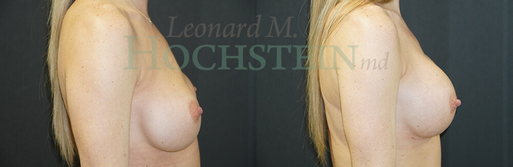 Breast Revision Patient
