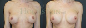 Breast Revision Patient