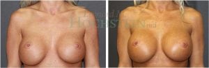 Breast Revision Patient