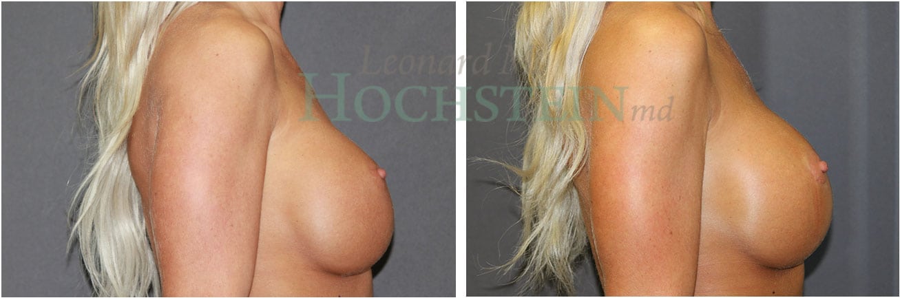 Breast Revision Patient