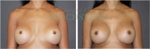 Breast Revision Patient