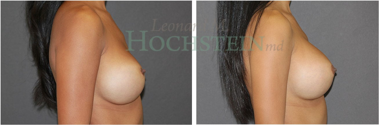 Breast Revision Patient