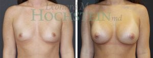 Breast Augmentation Patient