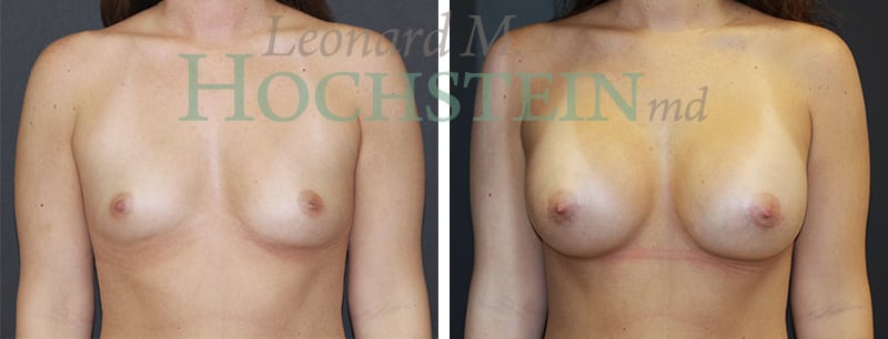 Breast Augmentation Patient