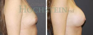 Breast Augmentation Patient